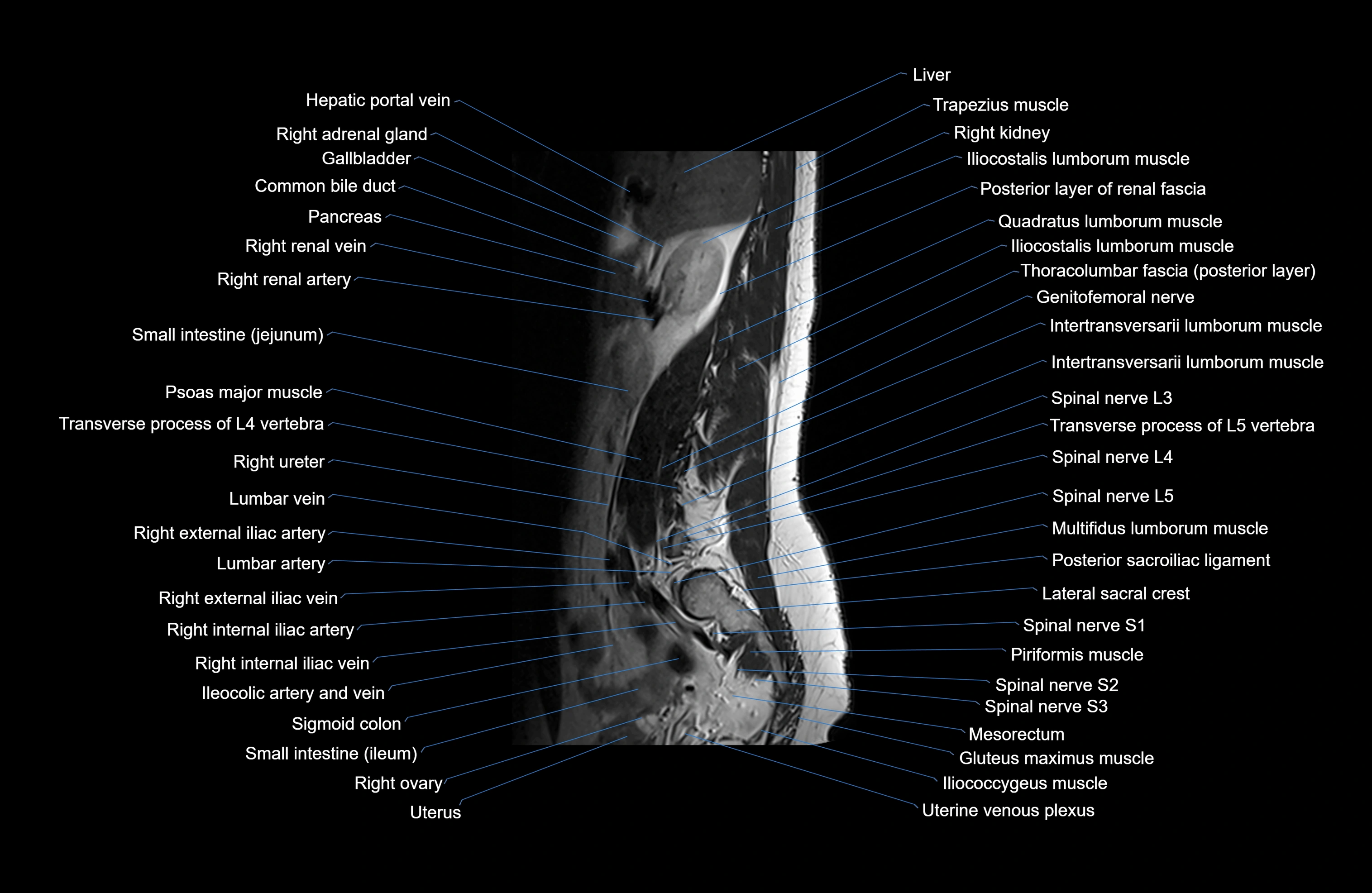 MRI lumbar spine sagittal cross sectional anatomy 3T radiology  image-img-00001-00001.webp